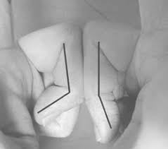 Image result for Elson Extensor Tendon Test