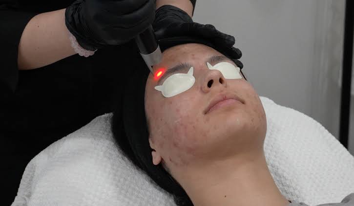 Can You Treat Acne and Acne Scars at the Same Time? – Total Wrapture Medi  Spa
