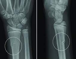 Check spelling or type a new query. Buckle Fracture Raleigh Hand Surgery Joseph J Schreiber Md