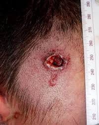 50 cal bullet wound / pistol round wound channels unless. Pathology Outlines Gunshot Wounds