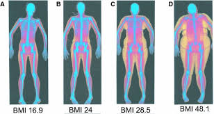 Body Scans Comparing Underweight Healthy Weight Overweight And Obese Post Body Scanning Underweight Obesity