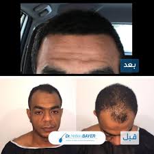 زراعة الشعر كيف تتم العملية وما هي المخاطر وكم التكلفة