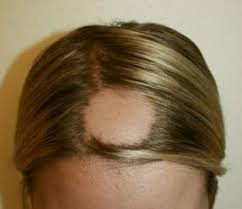 Les injections de prp cheveux boostent les cellules. Chute De Cheveux Et Pelade Une Solution Avec L Aromatherapie A Decouvrir