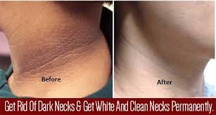 Dark Patches Usually Appear On The Neck Armpits And Inner Thighs Due To Waxing Shaving Using Deod Dark Patches On Skin Dark Skin Around Neck Dark Underarms