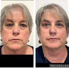 David Eric Tuggle DDS FAACS ABFCS (@faceliftsphoenix) • Instagram photos  and videos