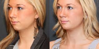Chin Implant Young Woman Google Search Chin Implant