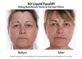 A lower facelift surgically redefines the jawline by eliminating jowls, minimizes the appearance of laugh or marionette lines, and tightens sagging cheeks. Sagging Face Sagging Facial Skin