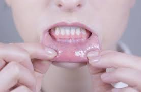 Image result for Lip Cancer