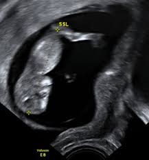 Die Gestationsaltersbestimmung Mit Ultraschall Springerlink