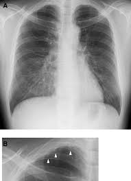What is apico lordotic means. Pleural Thickening On Screening Chest X Rays A Single Institutional Study Respiratory Research Full Text