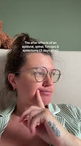 After Effects of Epidural and Forceps Delivery