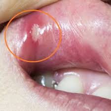 Cara menghilangkan bau mulut dengan garam epsom: Cara Rawat Ulser Mulut Punca Langkah Yang Perlu Diambil Bila Terkena Penyakit Ini Encikshino Com