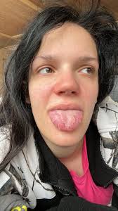 angiography] [dural arteriovenous fistula] [dAVF] Hello, everyone. I'm  hospitalized right now, this is my 4th hospitalization since I received the  TM diagnosis last September. I'm taking +10 medications to poop but I