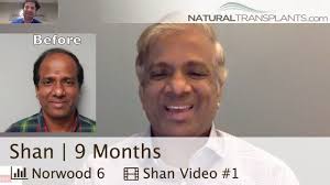 Hair Transplant Before and After FUT