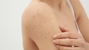 Image result for scabies effects on the human body