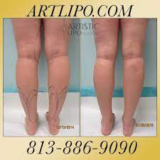Liposuction Tampa Sarasota Orlando Clearwater Stpetersburg Florida By Dr Su Ankles Cankles Kankles Calves Legs Liposuction Thigh Liposuction Arm Liposuction