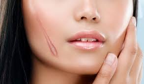 Kết quả hình ảnh cho sẹo lồi