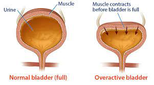 Overactive bladder (oab) syndrome means that the bladder, which is a bag made of muscle, squeezes (contracts) suddenly without you having . Overactive Bladder Activity Oab Model Creative Biolabs