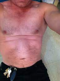 Check spelling or type a new query. 47 Yo Male Had Umbilical Hernia Repaired 5 Yrs Ago Abdominal Muscles Now Separating Next Step Photo