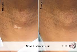 In some instances, ink placement over scar tissue can instead of using ink to cover up a scar, how about looking at the big picture and working it into a tattoo design? Scar Treatment By Microart Semi Permanent Scar Camouflage