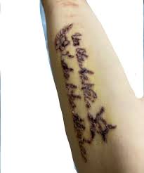 タトゥーレーザー治療後1週間 | タトゥーのレーザー治療記録