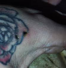 Image result for wolf spider bite skin