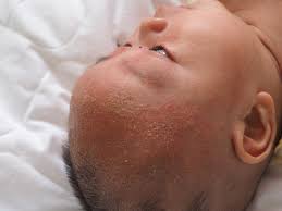 Check spelling or type a new query. Seboroicka Dermatitida Odborna Aj Domaca Liecba