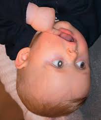 Leukokoria in advanced retinoblastoma as seen in a typical family...