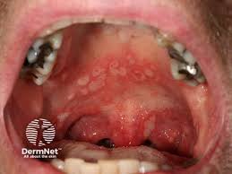 Image result for Canker sores symptoms roof of the mouth