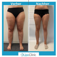 Lipoclinic Dr Heck Home Facebook