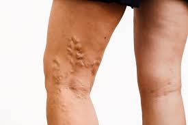 Varicose veins can occur in almost anyone and affect up to 35% of people in the united states. Cost Of Varicose Vein Removal Vinay Madan Md Dabvlm Board Certified Vascular And Interventional Radiologist
