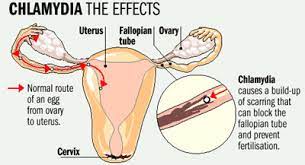 Extreme Hair Solution Why Chlamydia Is The Major Cause Of Infertility