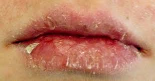 Image result for Lip Cancer