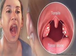Daftar isicara merawat wajah berminyak1. Merawat Bengkak Tonsil Dengan Vitamin Sentiasa Panas