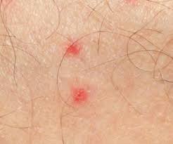 Erythematous lesion with peripheral purpura on the face. How To Treat Pinpoint Petechiae 21 Natural Home Remedies