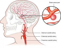 The brain aneurysm foundation is the globally. Brain Aneurysm Informedhealth Org