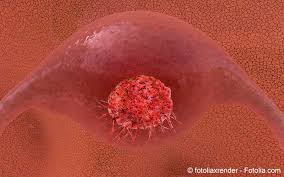 Introduction vaccine hesitancy is a complex public health issue referring to concerns about the safety, efficacy or need for vaccination. Gebarmutterhalskrebs Zervixkarzinom Meine Gesundheit