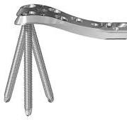Variable Angle LCP™ Curved Condylar Plate | DePuy Synthes ...