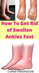How To Get Rid Of Swollen Ankles Fast Swollen Feet Remedy Foot Remedies Swollen Ankles