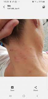 Here are allergy rash home remedies. How To Stop The Infernal Itching Caused By Brown Tail Moth Caterpillar Penbay Pilot