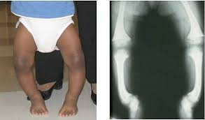 علاج لين العظام (الكساح) بالاعشاب والغذاء والطب البديل - لحن الحياة