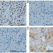 Genomic studies of malignant mesothelioma (mm) have identified frequent mutations in brca associated protein 1 (bap1), a nuclear deubiquitinase . Bap1 Nuclear Staining By Immunohistochemistry A Rcc09 Showing Download Scientific Diagram