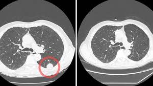 Start page/computed tomography (ct)/thorax (chest) ct scan. Current Former Heavy Smoker Ct Lung Screening Saves Lives