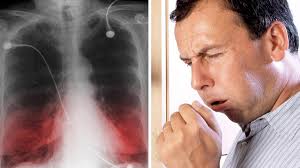Copd patients present with progressive dyspnoea and chronic productive cough. Copd Wenn Auf Cortison Verzichtet Werden Kann Welt