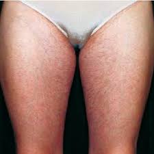 Apply this mixture on your buttocks and give a massage for 10 minutes. Hypertrichosis Of The Inner Thighs Due To Topical Testosterone Cream Download Scientific Diagram