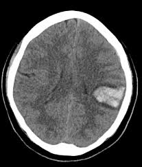 Le conseguenze dell'emorragia cerebrale dipendono dalla causa, dalla gravità iniziale e dalla tempestività dei soccorsi: Emorragia Intracerebrale Malattie Neurologiche Manuali Msd Edizione Professionisti