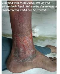 Image result for Stasis Dermatitis