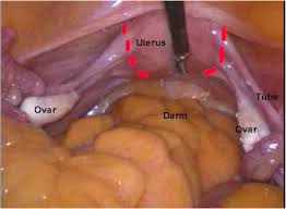 Übertragen von bildern von der kamera auf das smartphone&quest; Https Villarsgyn Ch Laproskop Hysterektomie
