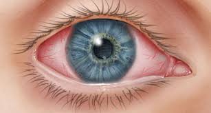 Image result for Conjunctivitis