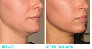 Collagen rebuilds itself and continues to grow for … How Much Is Ultherapy In Tampa Cost Skin Tightening Arviv Medical Aesthetics